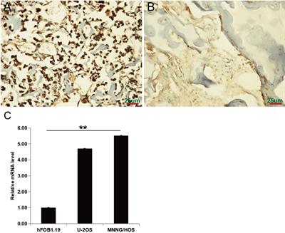 Aberrant Expression of PAFAH1B3 Affects Proliferation and Apoptosis in Osteosarcoma